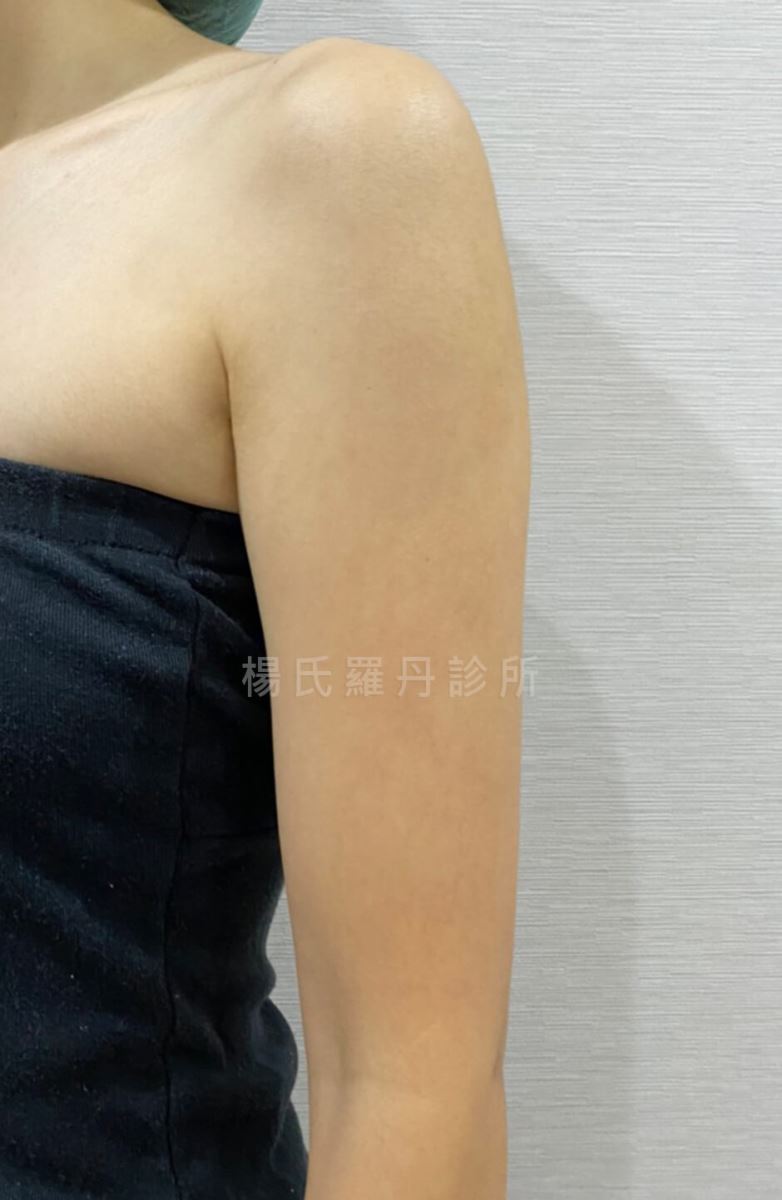 減脂 雷射減脂 減脂手術