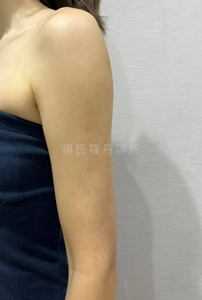 雷射減脂 瘦手臂 雕塑