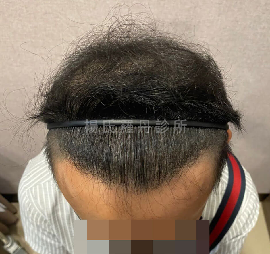 植髮 植髮手術 生髮613