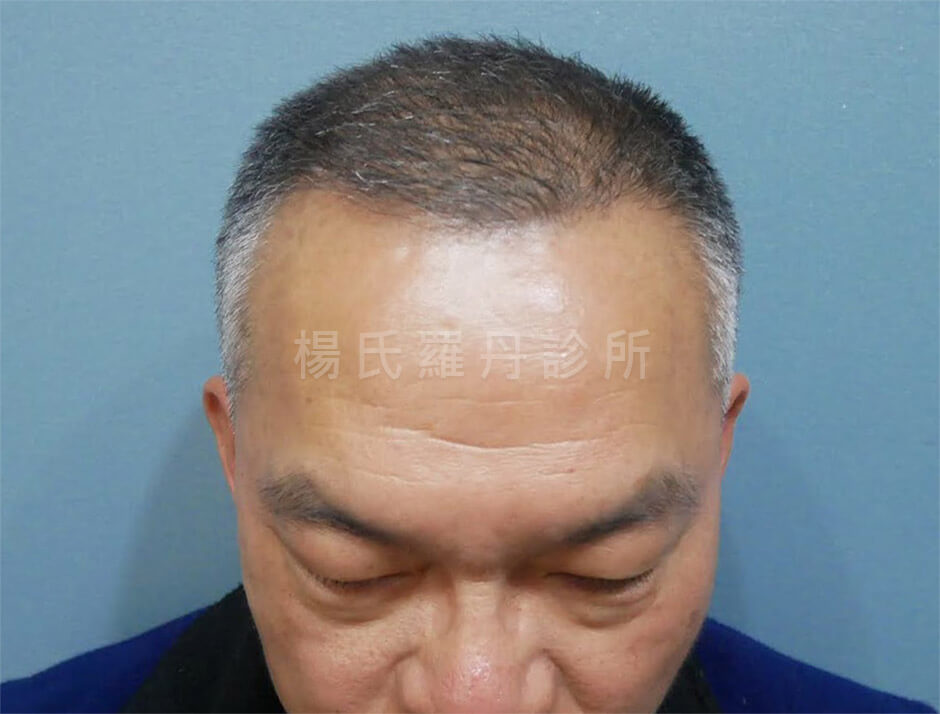 植髮 生髮 禿頭 生髮613