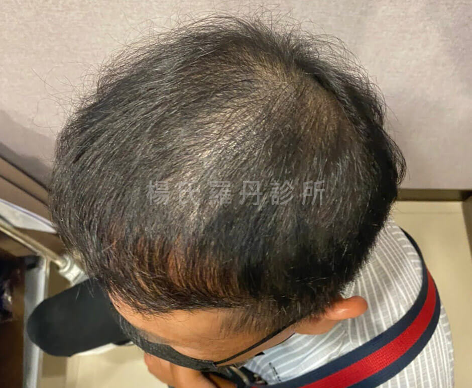 植髮 植髮效果 生髮613