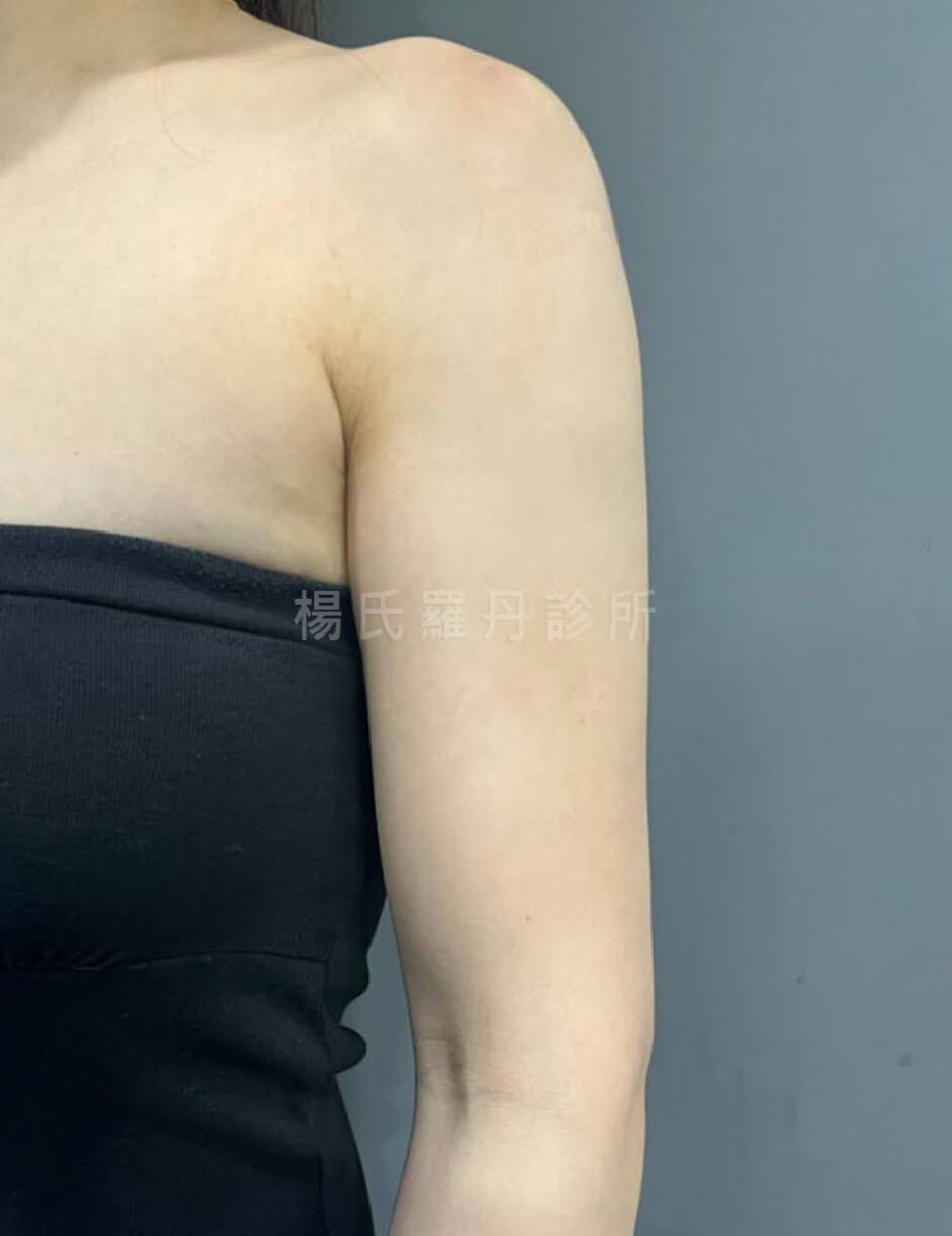 雷射減脂 減脂 雕塑