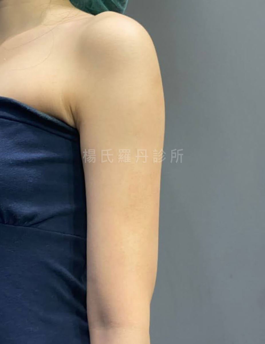 減脂 雷射減脂 減脂手術