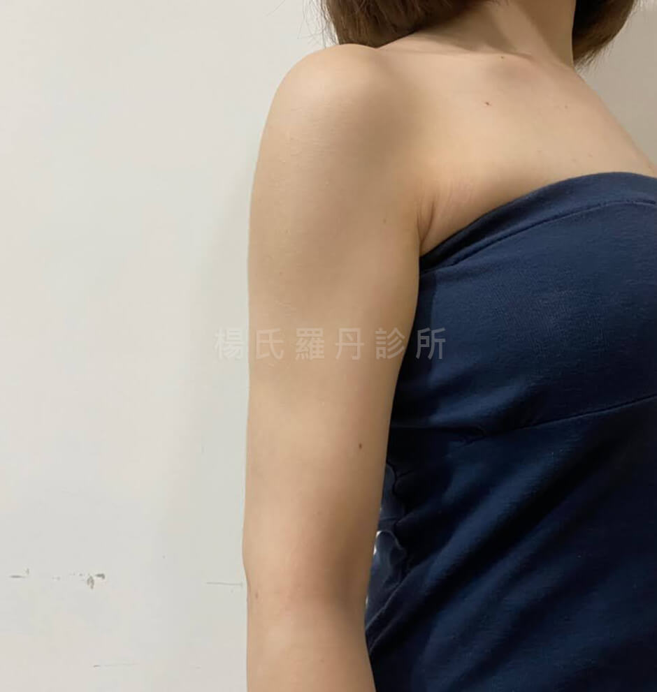 雷射減脂 蝴蝶袖 減脂