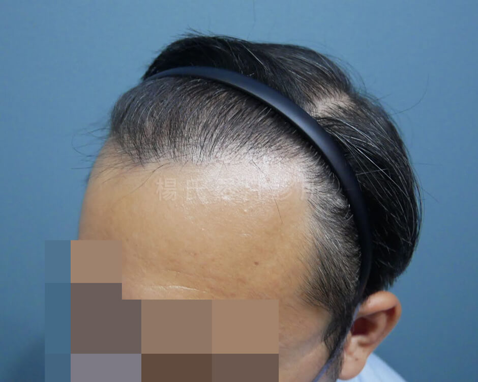 植髮 掉髮 雄性禿