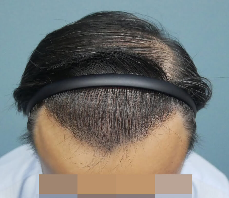 植髮 雄性禿 植髮手術