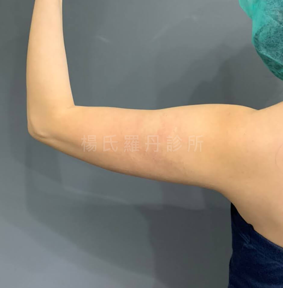 瘦手臂 雷射減脂 減脂