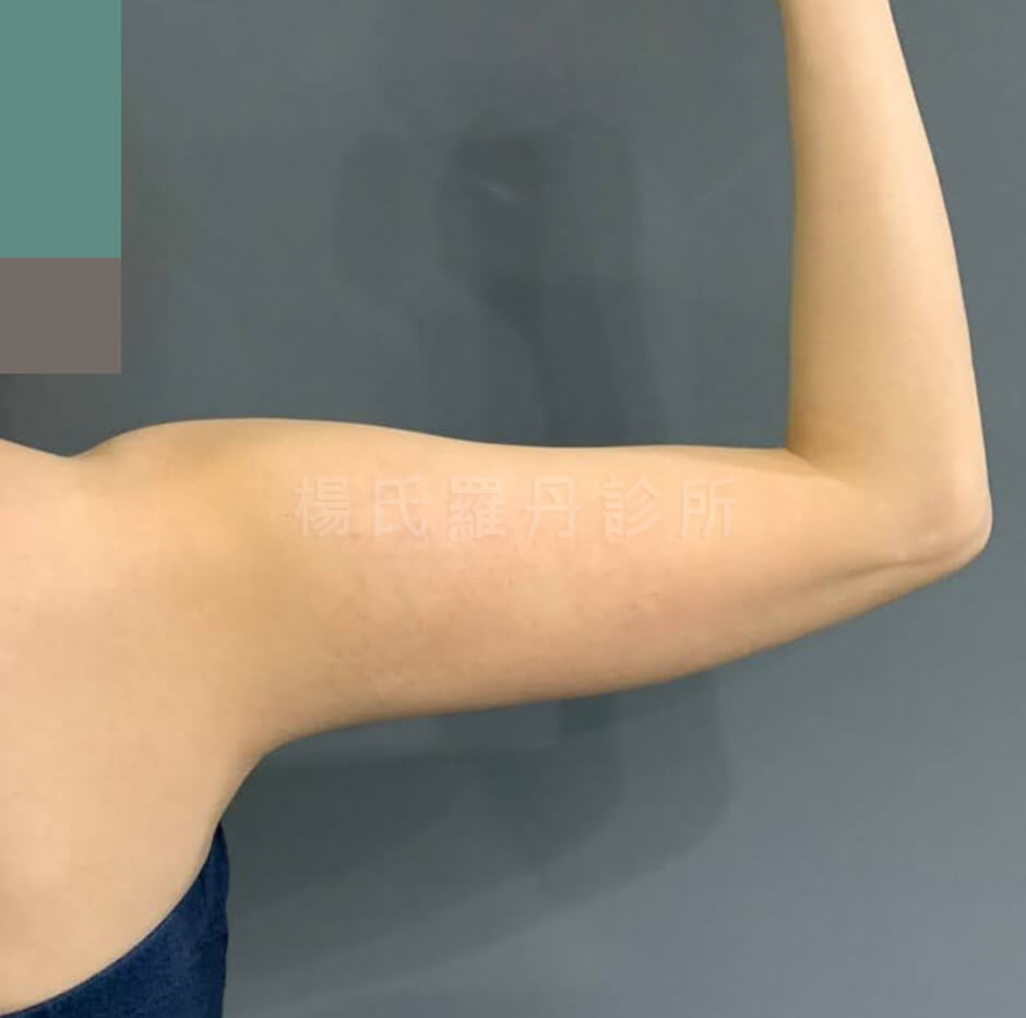 減脂 抽脂 雷射減脂