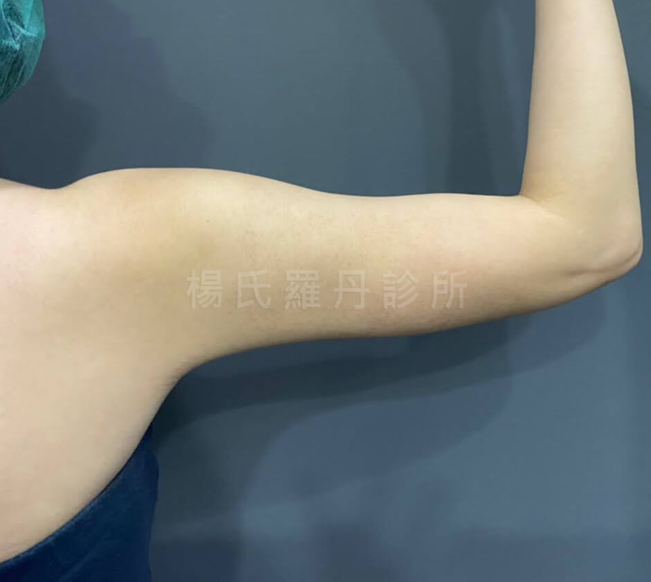 雷射減脂 抽脂 減脂