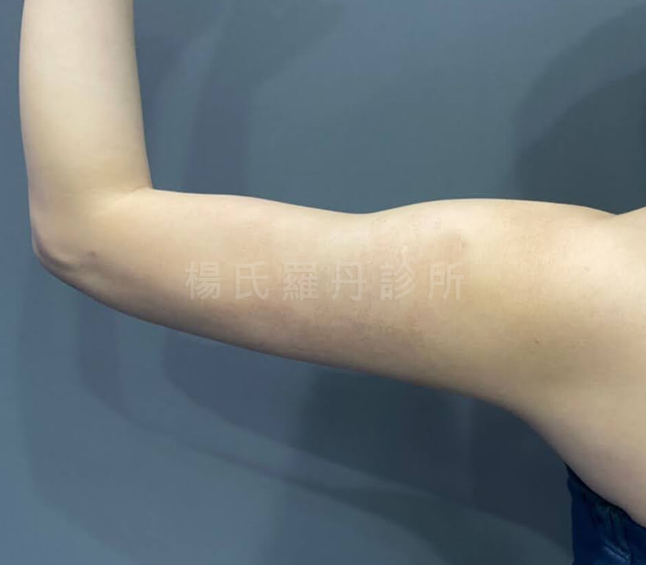 雷射減脂 抽脂 蝴蝶袖 減脂