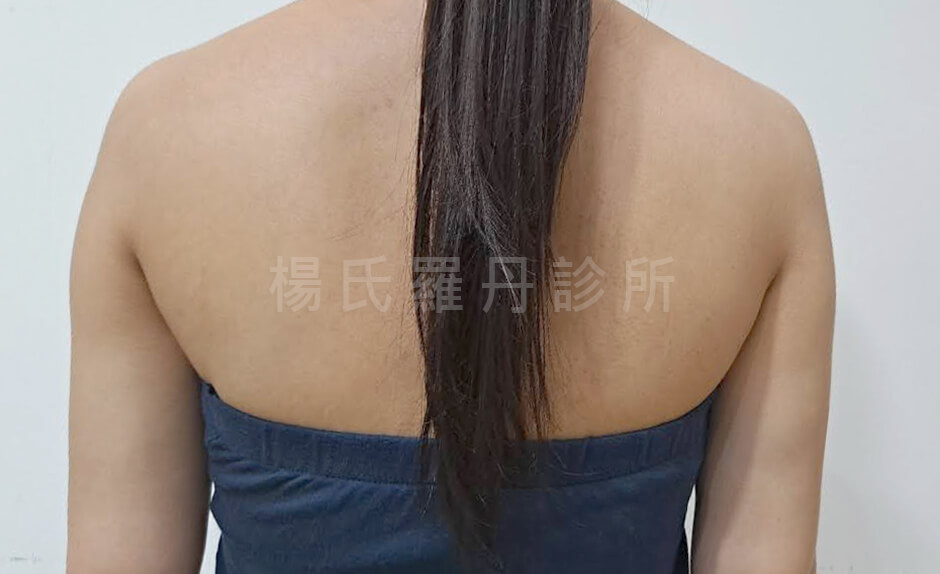 瘦手臂 減脂 雷射減脂