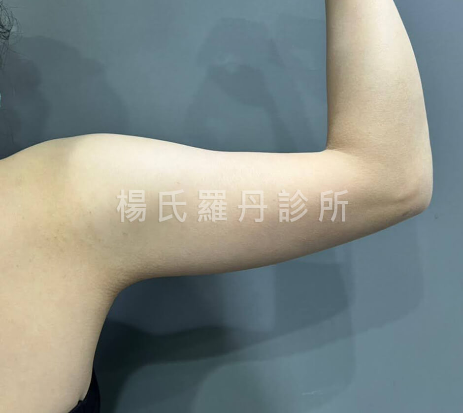 減脂 減脂手術 雷射減脂