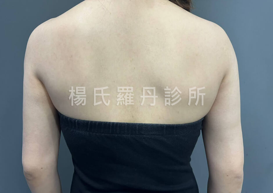 抽脂 雷射減脂 瘦手臂