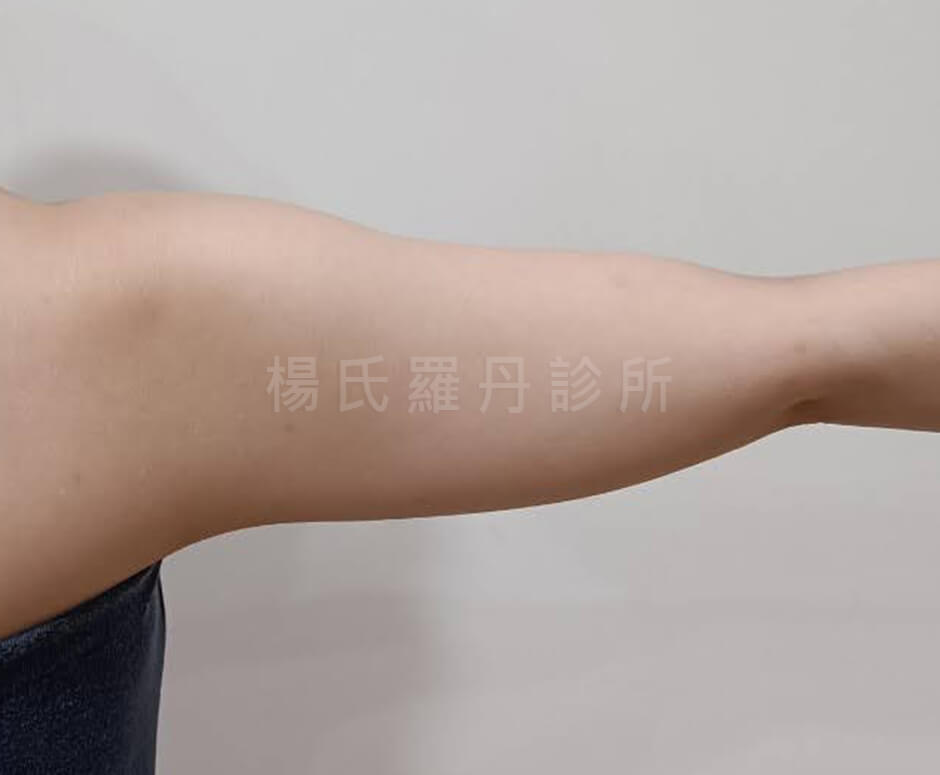 減脂 雷射減脂 瘦手臂