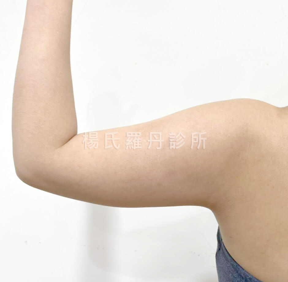 抽脂 減脂 手臂抽脂