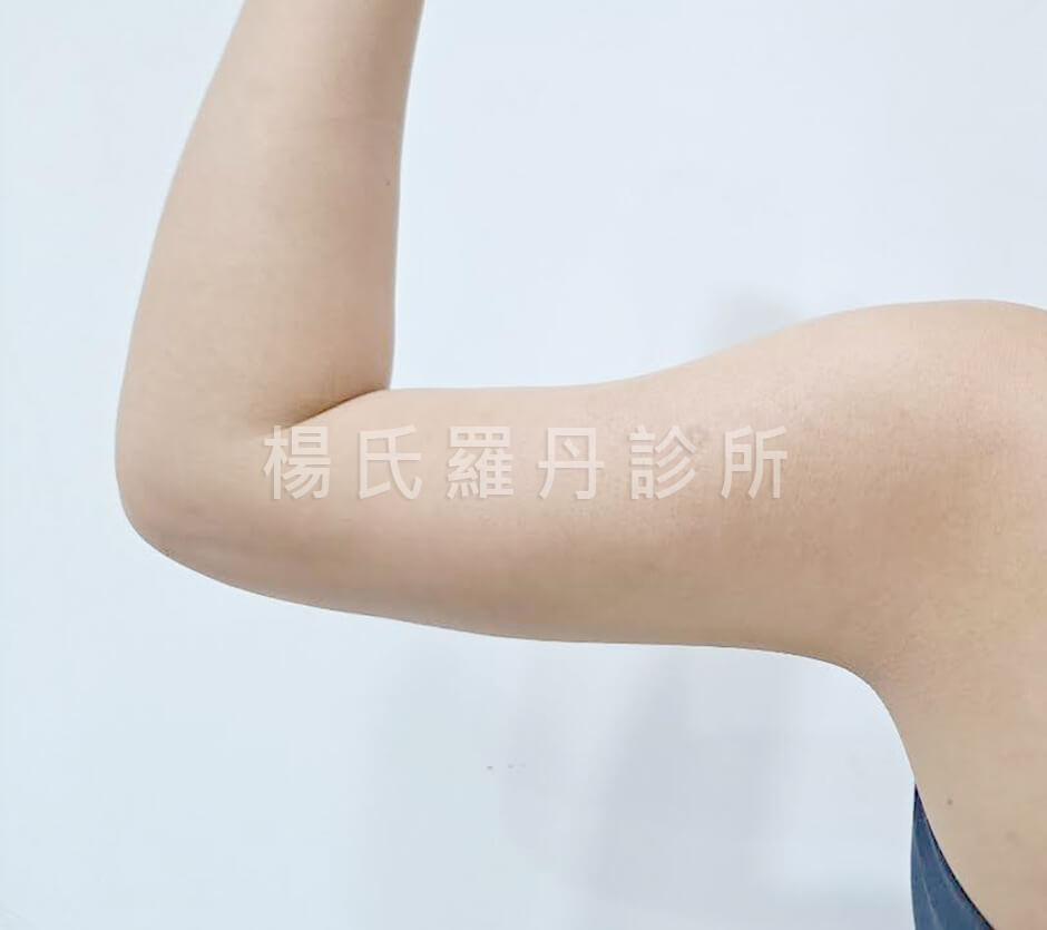 抽脂 雷射減脂 減脂