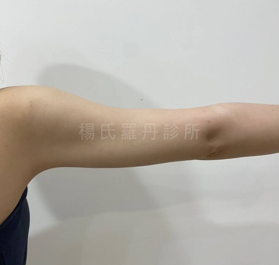 雷射減脂 減脂 瘦手臂