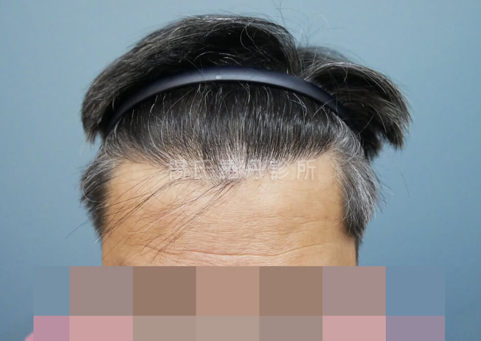 植髮 植髮手術 髮際線