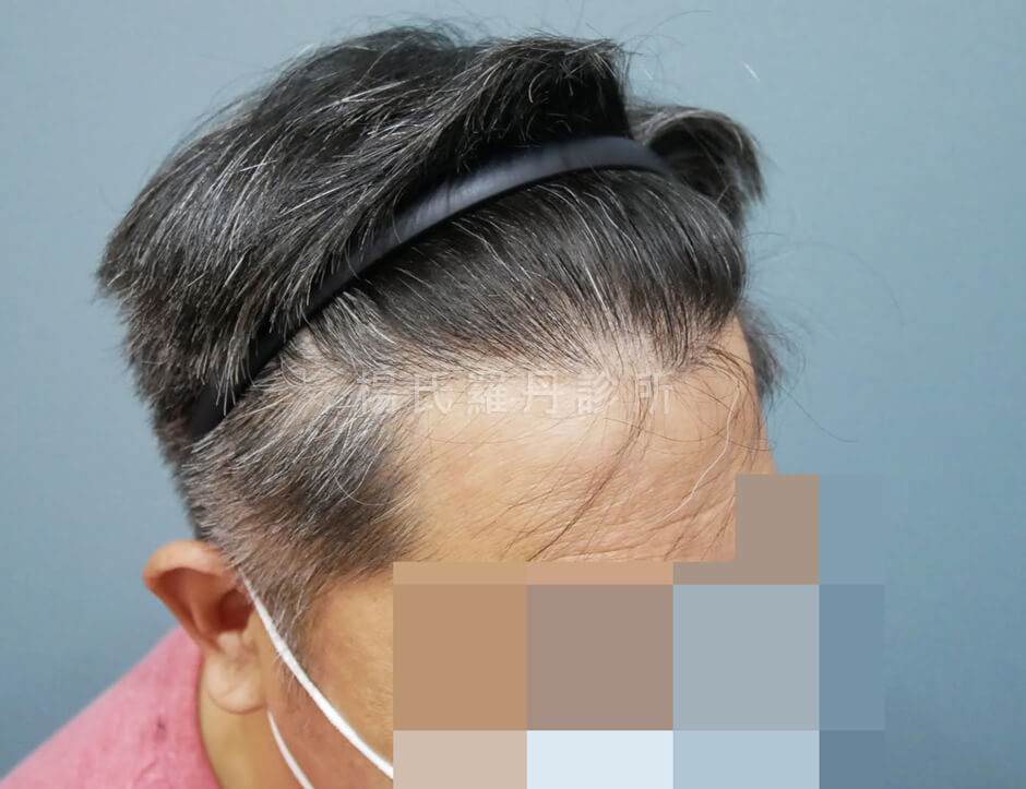 植髮 禿頭