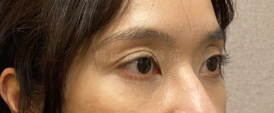 眼袋 眼袋手術 淚溝