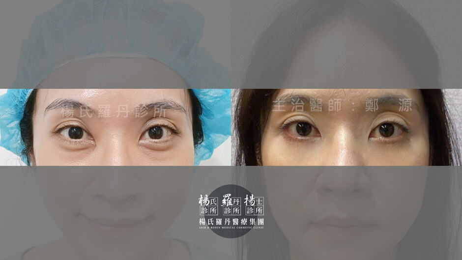 眼袋 淚溝 眼袋手術 眼袋消除