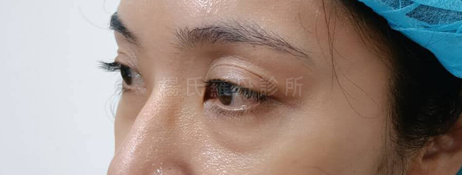 眼袋 淚溝 眼袋手術
