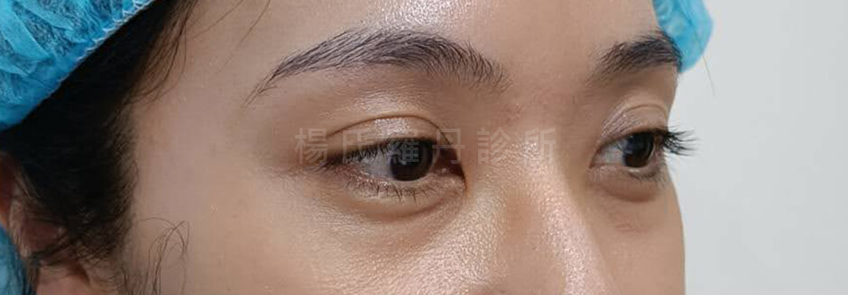 眼袋 除眼袋