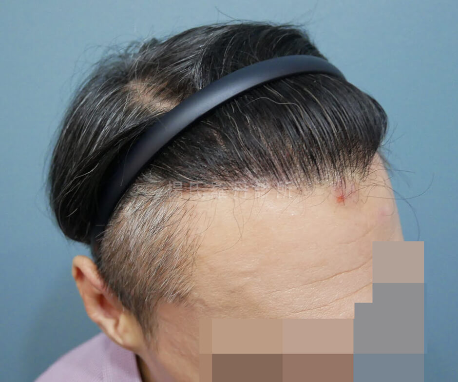 植髮 禿頭 植髮手術