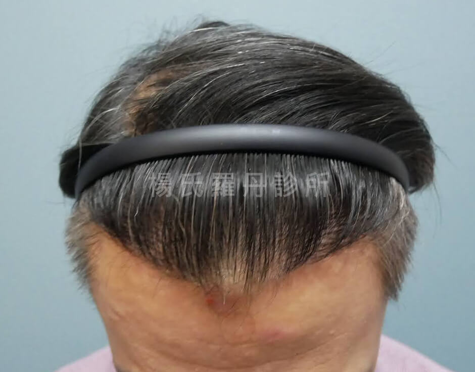 植髮 植髮成果