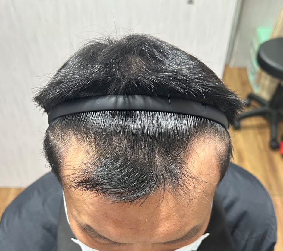 生髮 生髮成果 禿頭