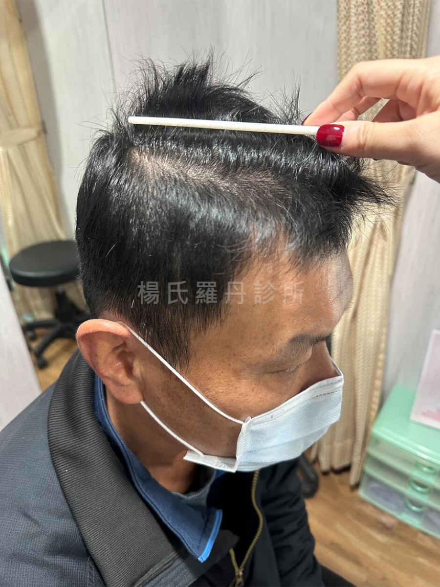 生髮 生髮療程