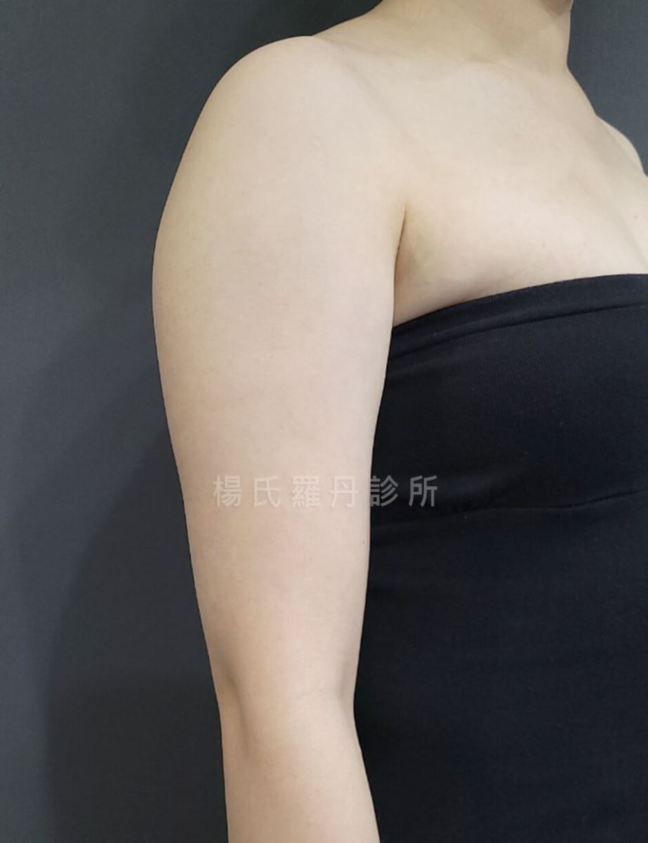 抽脂 手臂抽脂