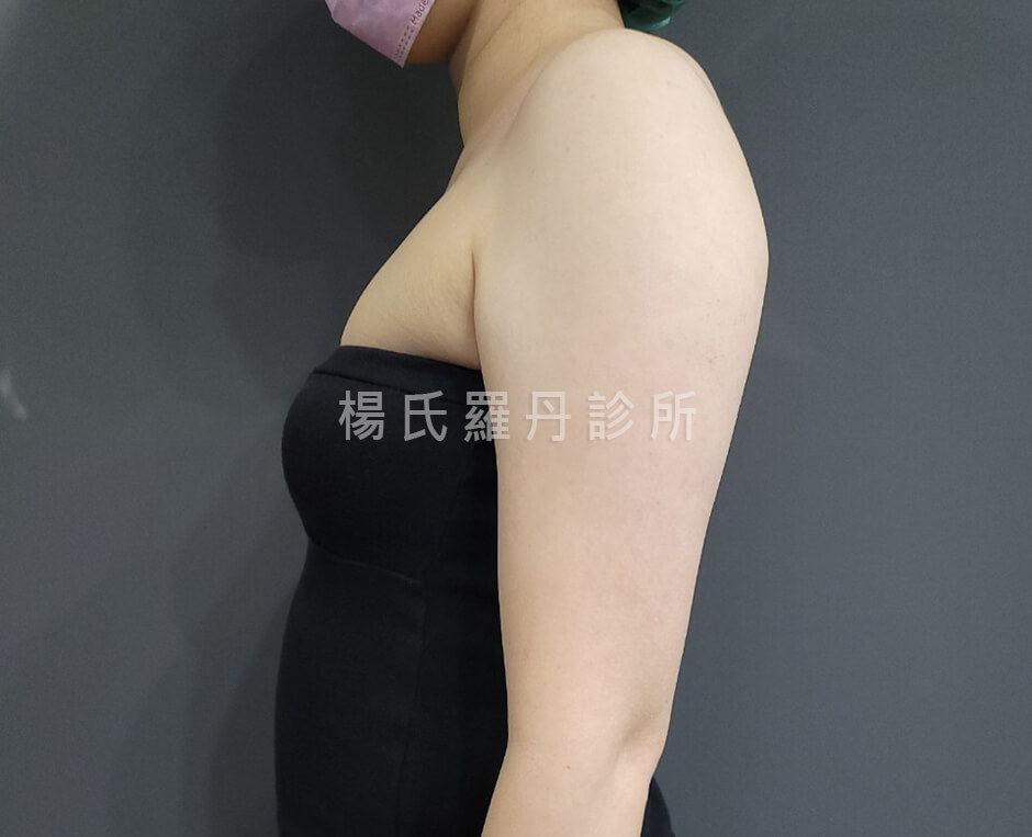 雷射減脂 減脂 減脂手術