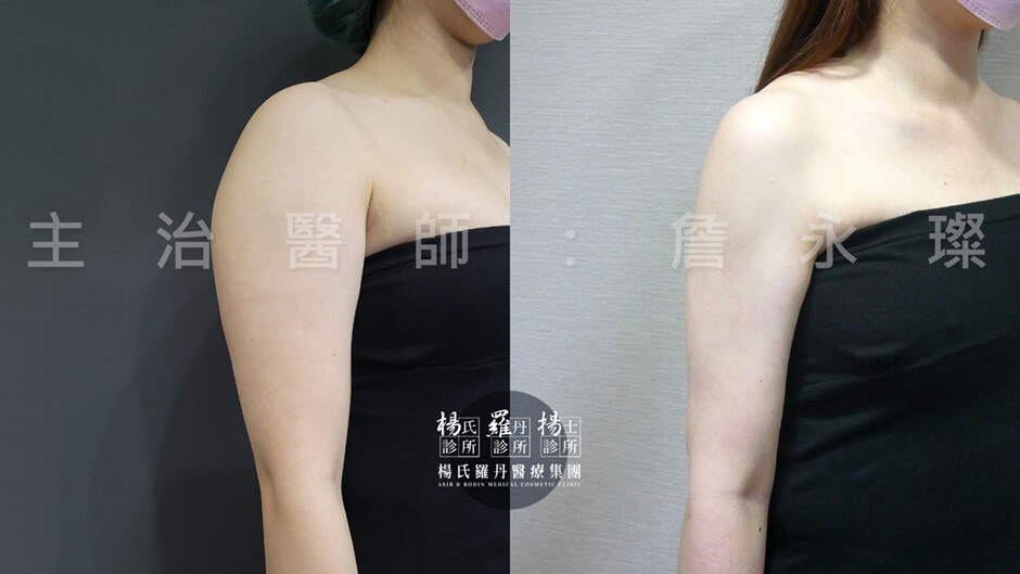 抽脂 手臂抽脂 雕塑
