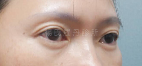 眼袋 眼袋手術 淚溝 除眼袋