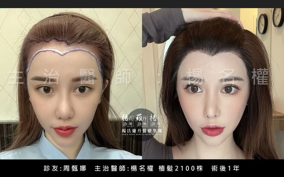 植髮 周甄娜 