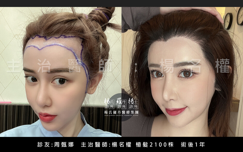 植髮 美型植髮 植髮手術