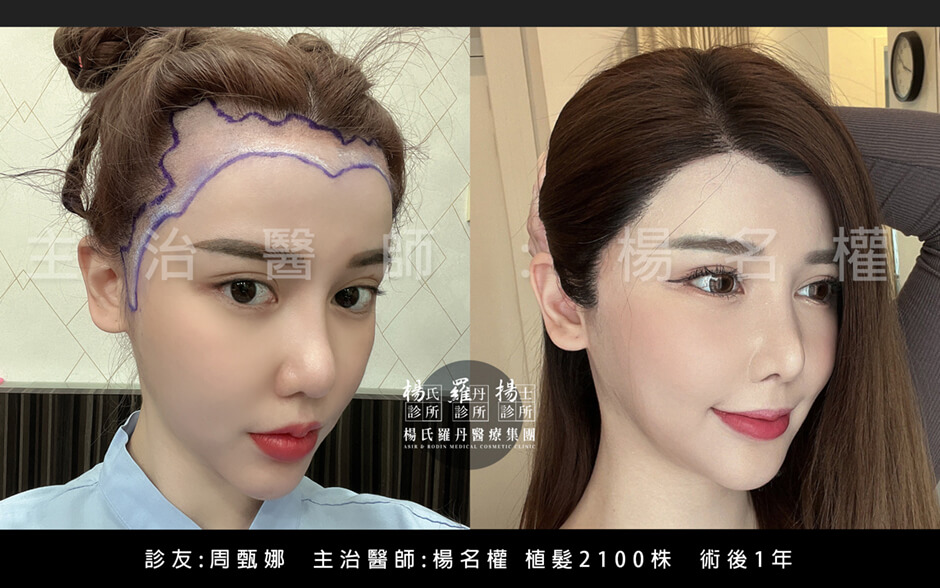 周甄娜 植髮 美型植髮