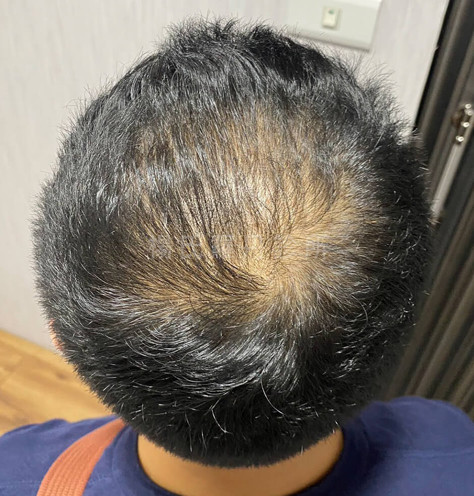 生髮 生髮治療  張泰山 生髮