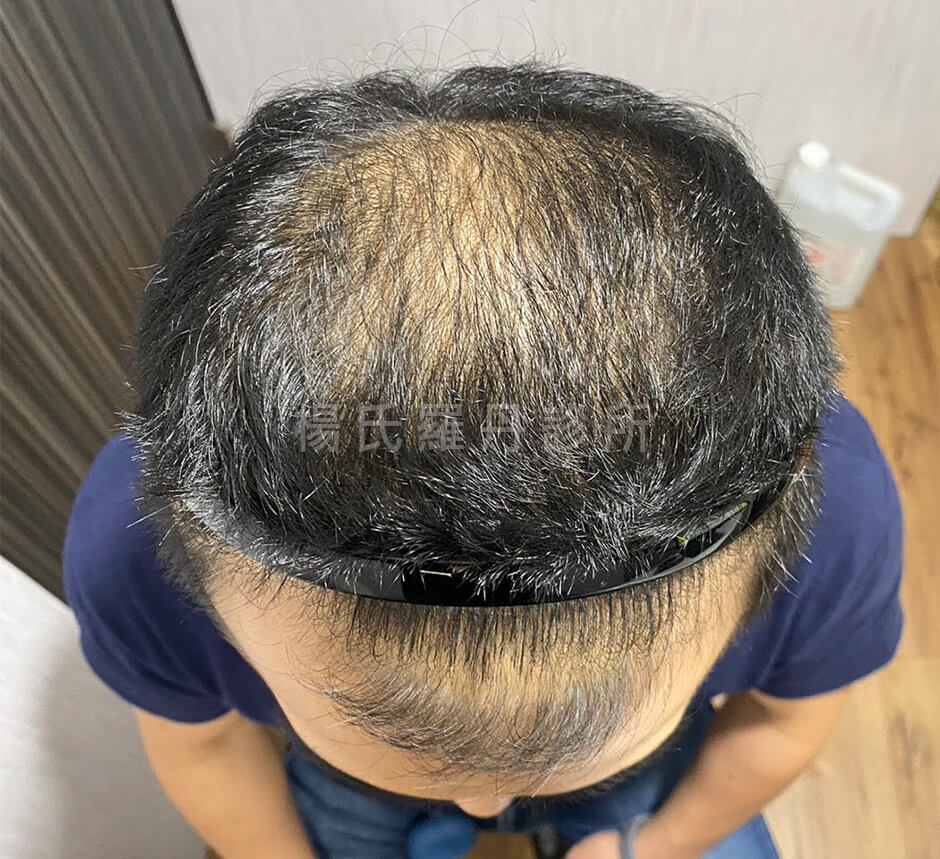 生髮 生髮效果