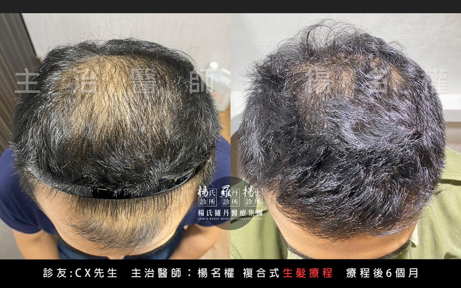 生髮 落髮 生髮治療