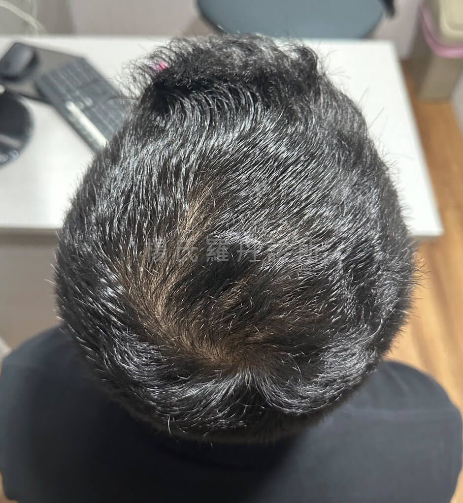 生髮 落髮 掉髮 張泰山生髮