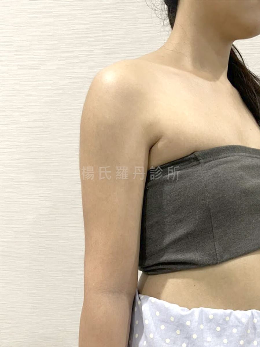 手臂抽脂 抽脂