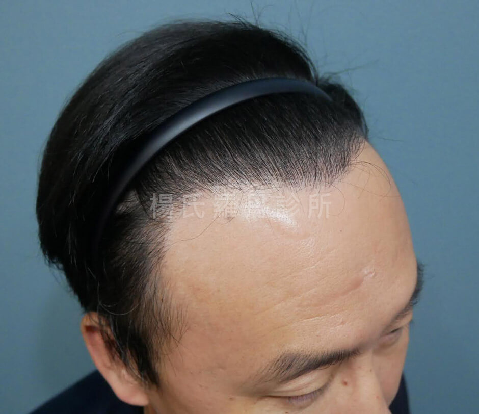 植髮 禿頭 髮際線