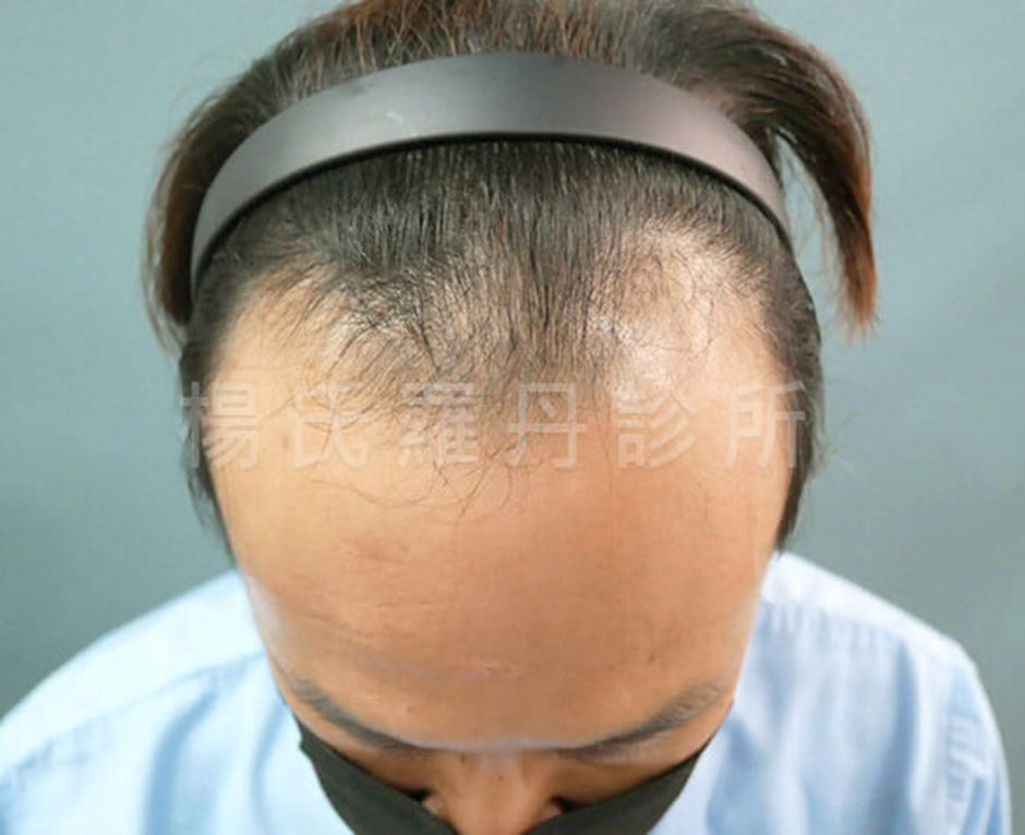 植髮 髮際線