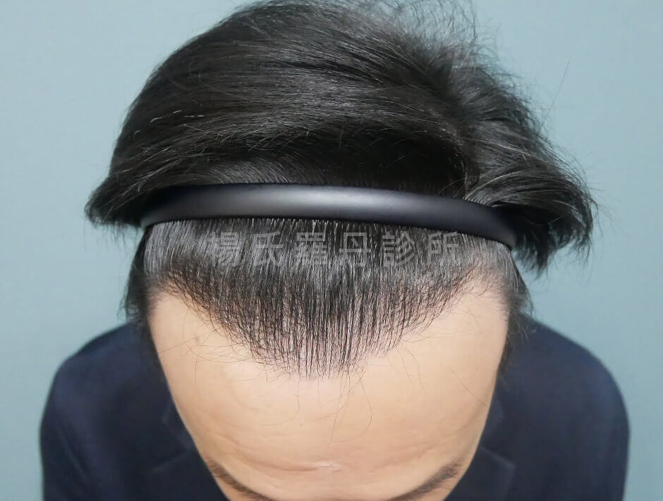 植髮 植髮手術 生髮613