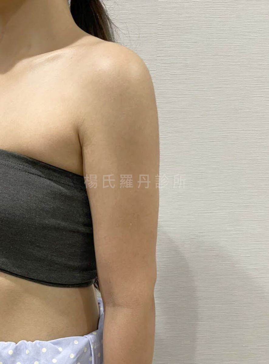 雷射減脂 減脂 減脂手術