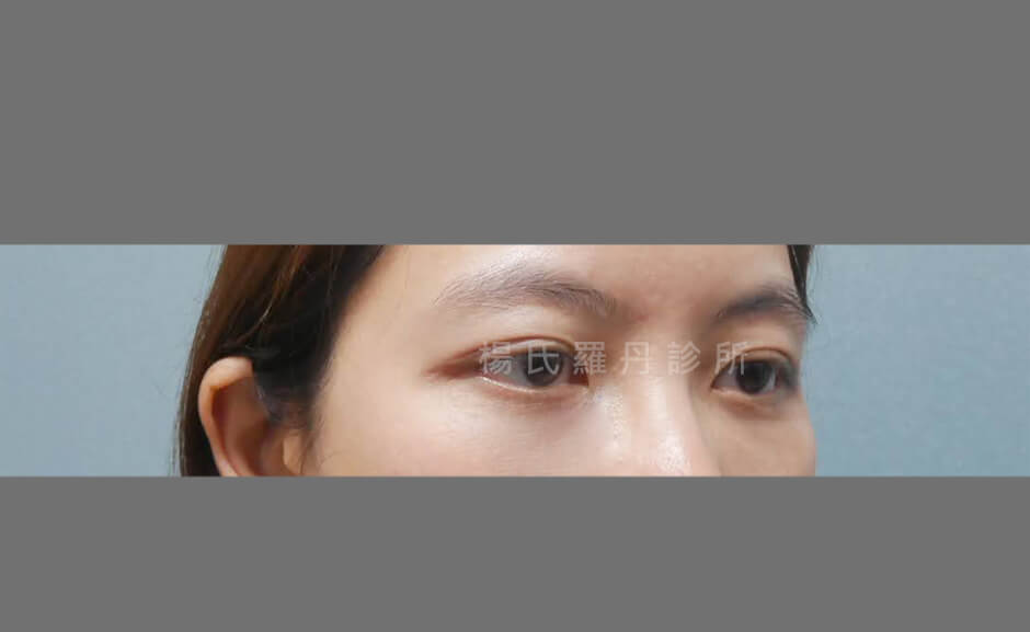 眼袋 眼袋手術 淚溝