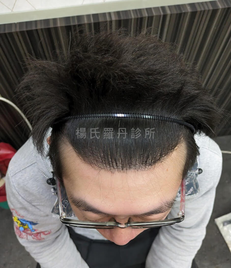 植髮 髮際線 植髮手術