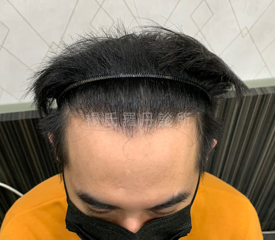 植髮 植髮效果